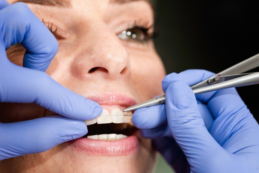 close up picture of woman getting dental braces