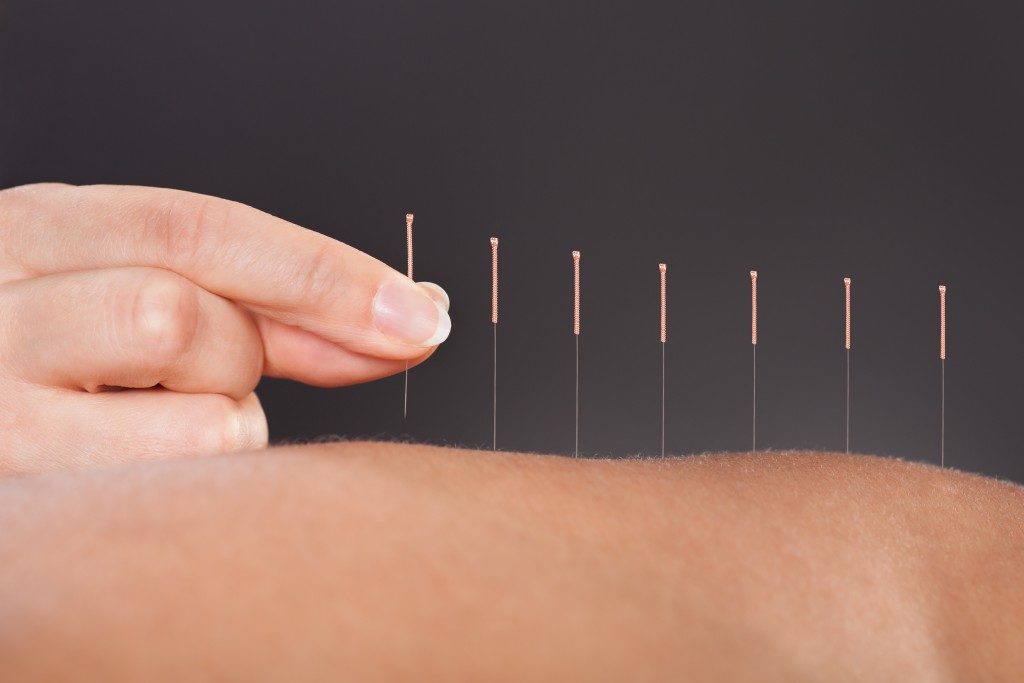 arthritis acupuncture